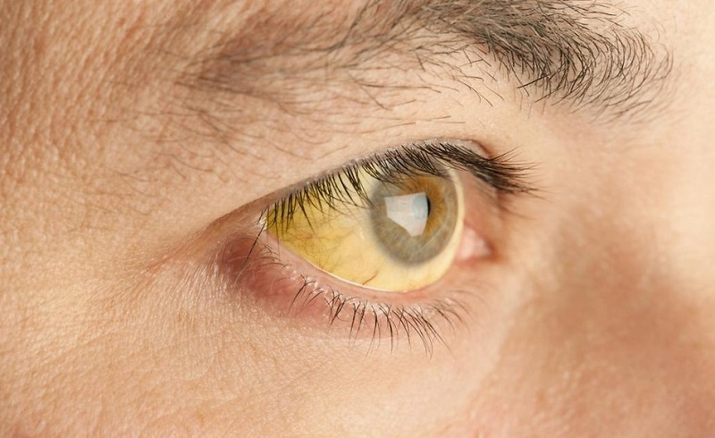 What are the Causes of Jaundice in Adults?